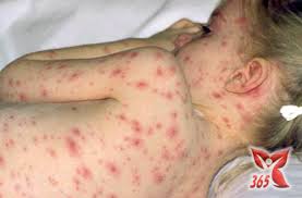 Cảnh báo: Dịch chồng dịch trong tuần nghỉ lễ